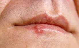 common sores and infections west