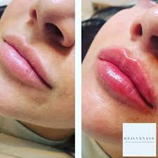 dermal fillers rejuvenate with alanna