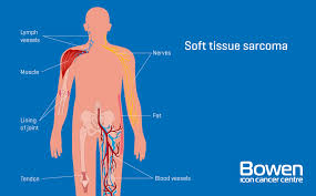 what is soft tissue sarcoma soft