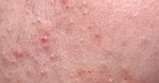 nodular acne causes treatment home
