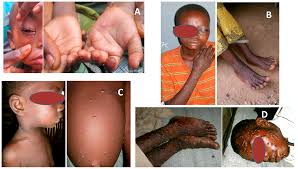 Two cases of rare viral infection found in the u.k. Viruses Free Full Text Improving The Care And Treatment Of Monkeypox Patients In Low Resource Settings Applying Evidence From Contemporary Biomedical And Smallpox Biodefense Research Html