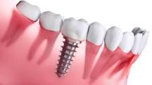 Image result for waterford dentist who does implants