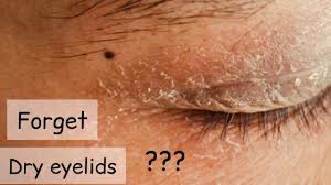 dry skin around eyelids treatment