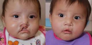 cleft lip and cleft palate nursing care