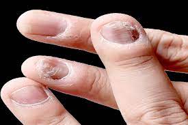 nail dystrophy discoloration and