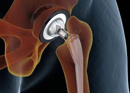 direct superior hip replacement