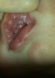 white patches inside lips pic included
