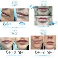 lips why we love restylane kysse pure