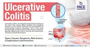 ulcerative colitis symptoms causes