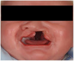 presurgical cleft lip and palate