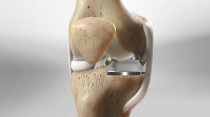 partial knee replacement dr rahul bade