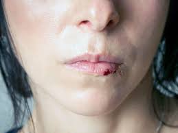 heal a deep cut inside the lower lip