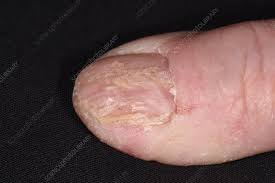 dystrophic nail in chronic eczema