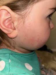 constant rash on toddlers face