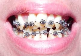 The remedies suggest that you don't have to use braces. Risks Of Do It Yourself Braces At Homedr Jacquie