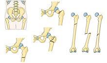 Click on the first link on a line below to go directly to a page where. Femoral Fracture Wikipedia