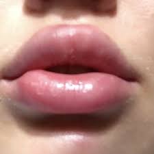 what is this indent in lower lip after