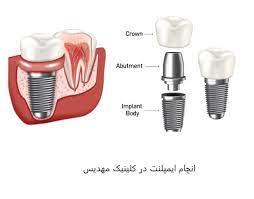 همه چیز در مورد ایمپلنت (کاشت) دندان | مهدیس کلینیک