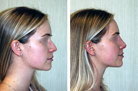Nose filler treatment usually involves injecting hyaluronic acid (ha) fillers into the skin. Non Surgical Nose Job New York Non Surgical Rhinoplasty