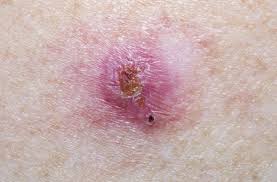 When malignant cancer cells form and grow within a person's breast tissue, breast cancer occurs. Basal Cell Carcinoma Cpd For General Practitioners