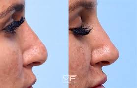 non surgical rhinoplasty before after