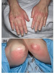 violaceous erythema and pas