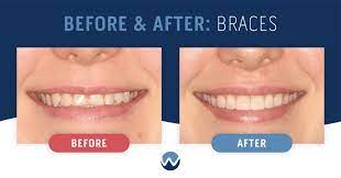 before after braces see the amazing