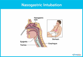 nasogastric intubation insertion