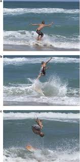 Skimboarding A New Cause Of Water Sport Spinal Cord Injury Spinal Cord