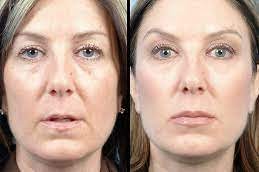 sculptra filler cost in dubai abu