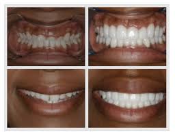 Surgery — dentists may recommend surgery to correct an underbite. Can Porcelain Veneers Be Used To Correct A Bad Bite Konig Center For Cosmetic Comprehensive Dentistry