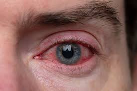 understanding corneal eye ulcers