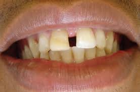 Once hardened, the dentist evens the bonded material out to ensure that the tooth appears even. Gaps Between Front Teeth Blouberg