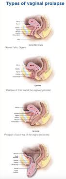 pelvic organ prolapse advane