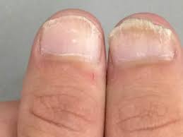 disorders of nails springerlink