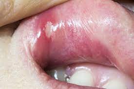 canker sore signs and treatment