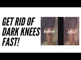 how to conceal dark knee asap