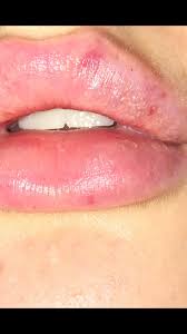 tiny white dots on lips after lip