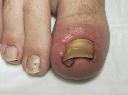 ingrown toenail removal singapore