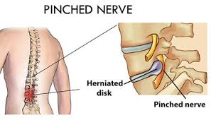 back pinched nerve treatment doctor nyc