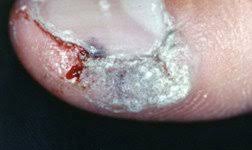 warts guide causes symptoms and