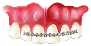 Dental splinting, used to treat loose teeth, involves joining teeth together. The Basics Of Splinting In Dentoalveolar Traumatology Intechopen