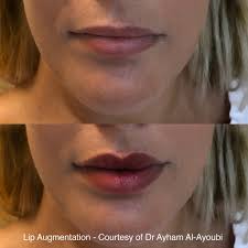 lip enhancement lip fillers harley