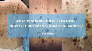 what is seborrhoeic keratosis kelowna