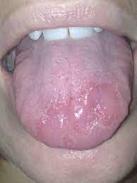tingling irritated tongue pic