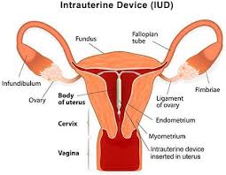 iud birth control nyc insertion removal