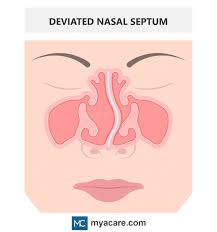 deviated septum symptoms diagnosis