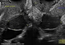 A pelvic ultrasound is the ideal imaging technique in pregnant women as it does not entail use of contrast or. Noninvasive Ultrasound Diagnosis Of Endometriosis