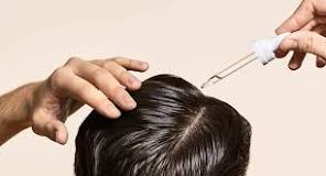 can-minoxidil-worsen-hair-loss