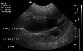 transverse ultrasound image of the left